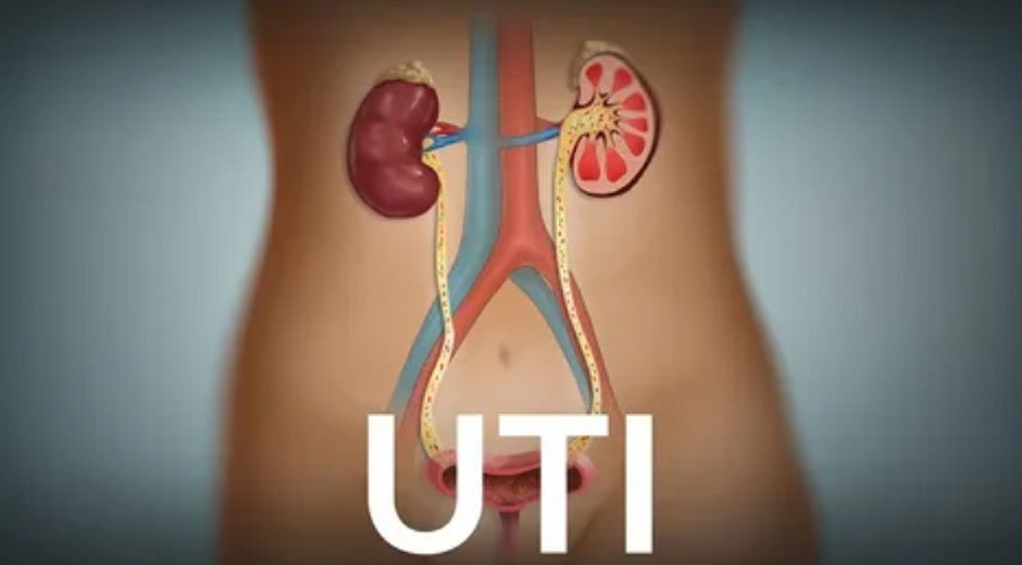 UTI Dyer and Innate Immune Skewing