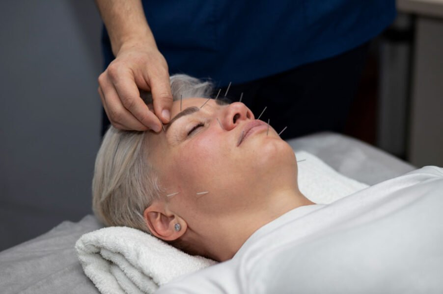 What Acupuncture Does for Anxiety and Stress Relief?